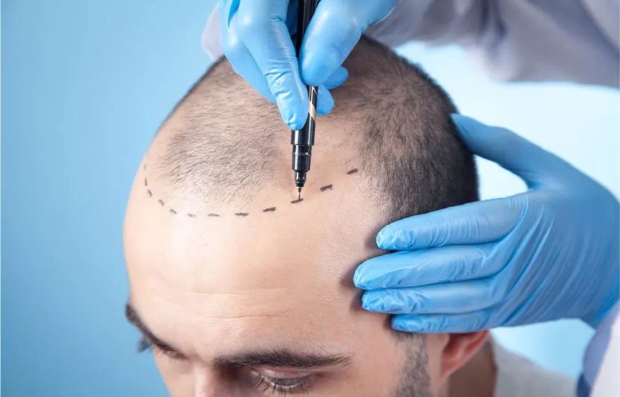 Before image for Hair transplant planning and procedure-stage example at Eteris Clinic Day Hospital
